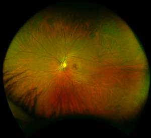 Glaucoma