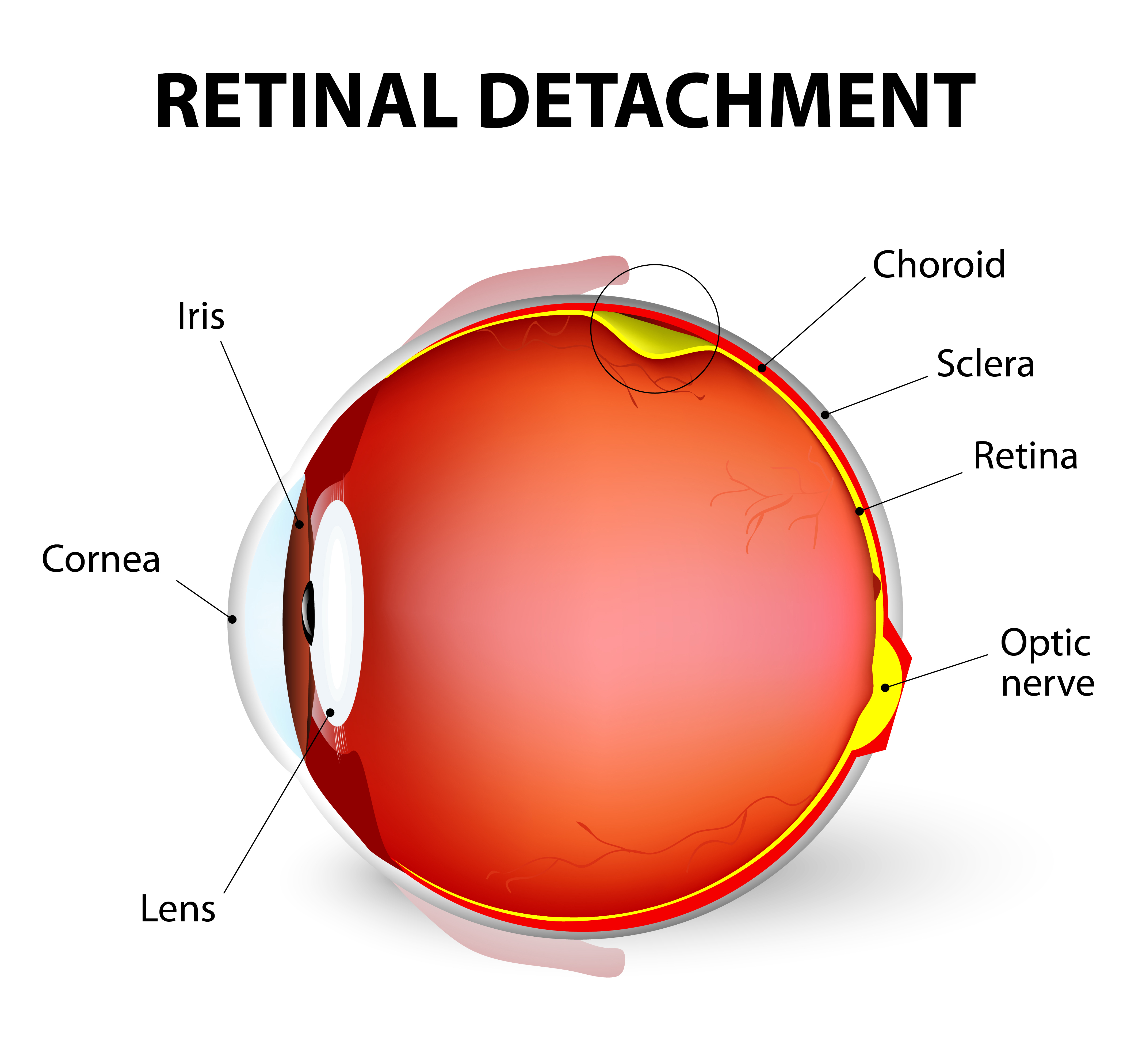 Retinal detachment